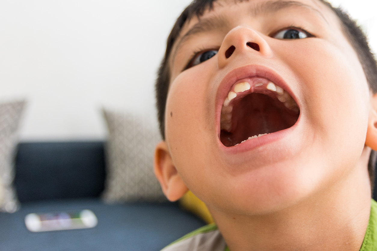 Child with mouth open showing adult teeth not coming in