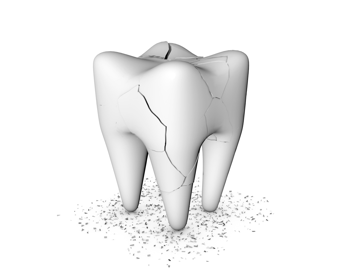 Stock image of a broken tooth