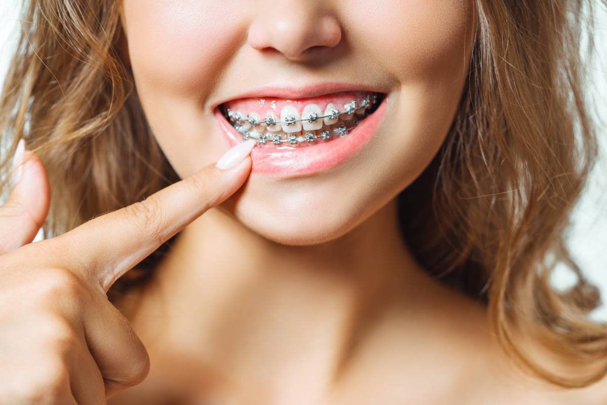 Stock image of a girl showing braces on her teeth