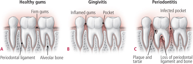 Graphical images showing Healthy gums, Gingivitis, Periodontics