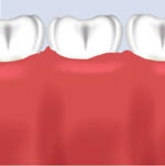 Image showing the bone augmentation material that will integrate with the bone and the gum that also return to normal