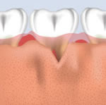 This transparent view shows the bone loss that has occurred from periodontal disease