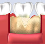 Image showing after filling the underlying bone loss with bone grafting material