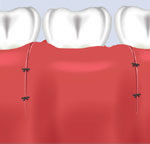 Image showing closed gum flap that allows the area to heal
