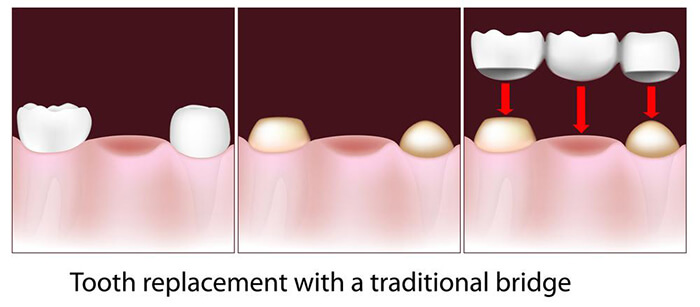 Graphical image explaining Tooth replacement with a traditional bridge