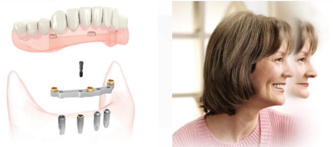 stock image showing dental implants and a woman smiling after having dental implants