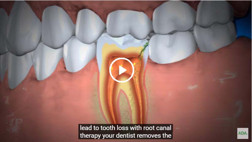 A video on Treatment of Abscessed Teeth - Click to see
