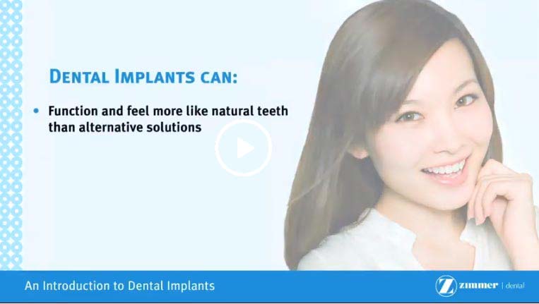 A video on dental implants - Click to see