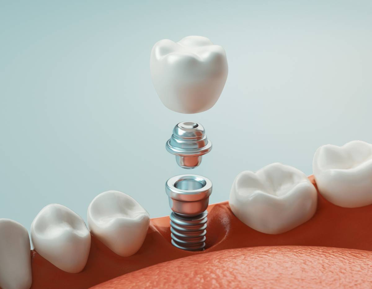 Stock image showing dental implant
