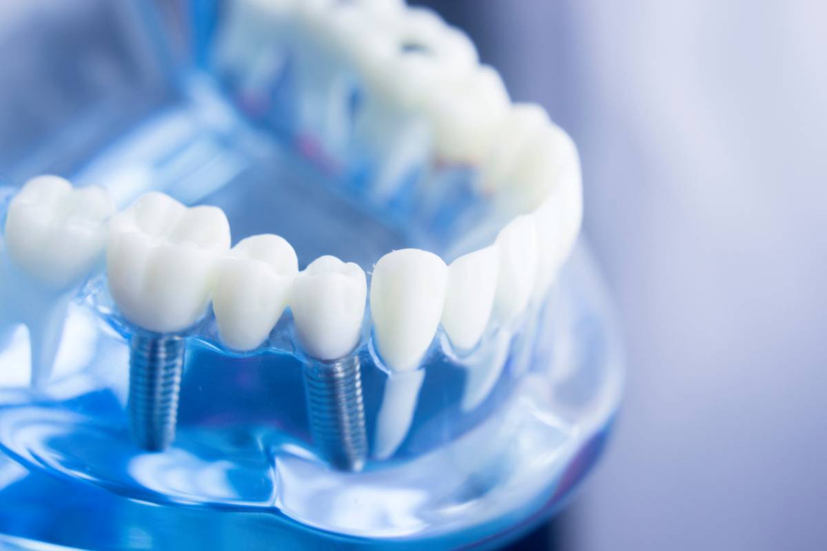 concept of tips for dental implant care