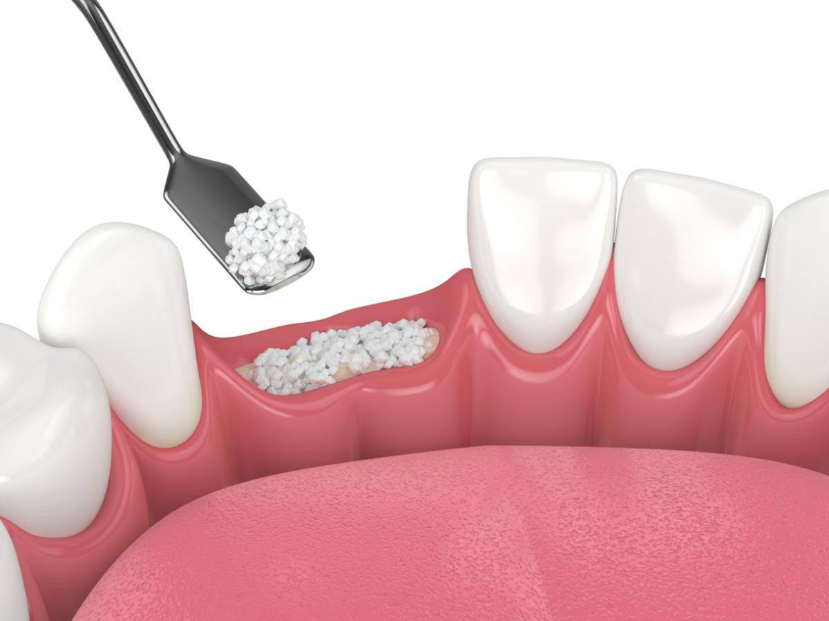 concept of bone graft before dental implants