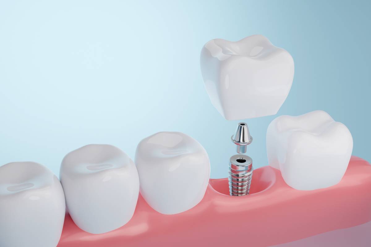 featured image for can dental implants be removed