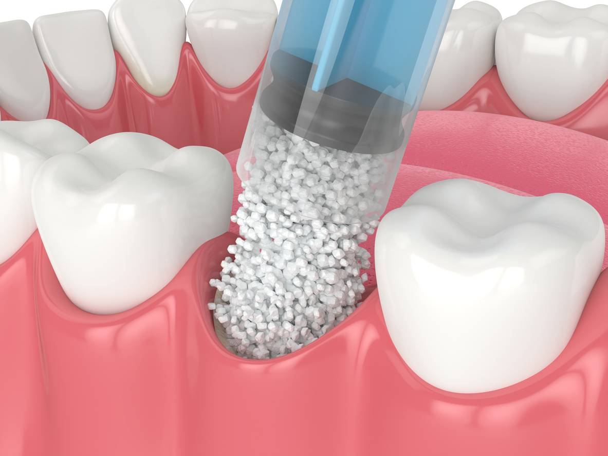 3D image representing the signs you need bone grafting.