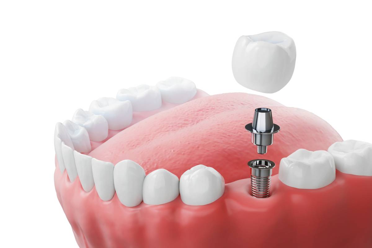 Featured image for How Do Screwless Dental Implants Work?