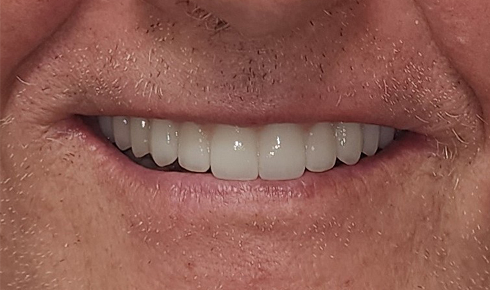 After image
