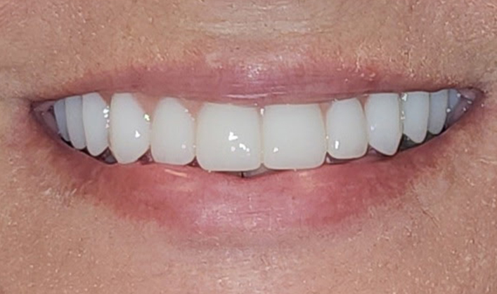 After image