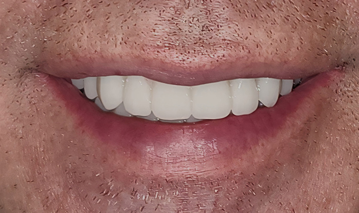After image