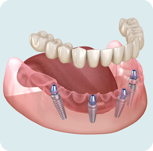 Mandibular prosthesis All on 4 system supported by implant image