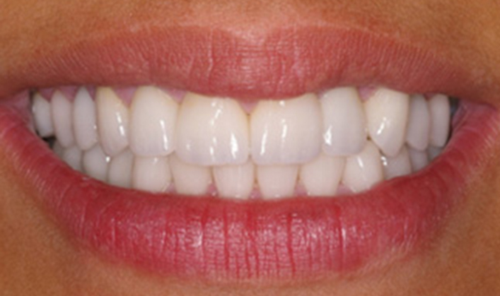 full mouth reconstruction with 9 implants and individual crowns on teeth and implants