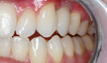 single implant and crown in a ‘single visit’