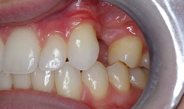 single implant and crown in a ‘single visit’