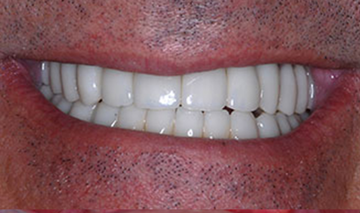 full mouth reconstruction with multiple implants and individual crowns on teeth & implants