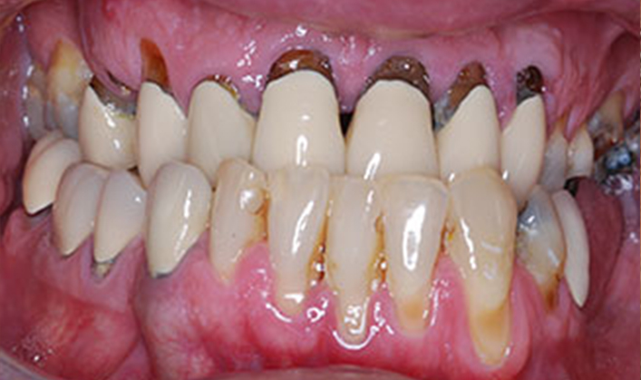 full mouth reconstruction with multiple implants and individual crowns on teeth & implants