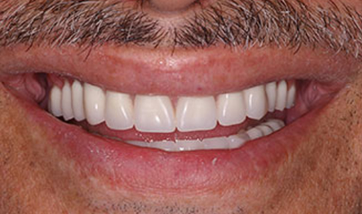 full mouth reconstruction with 2 full arch bridges and 12 implants
