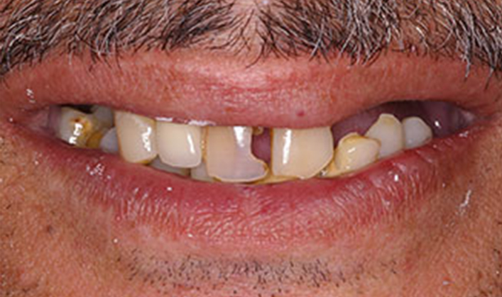 full mouth reconstruction with 2 full arch bridges and 12 implants