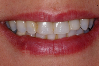 full mouth reconstruction with multiple implants and individual crowns on teeth & implants