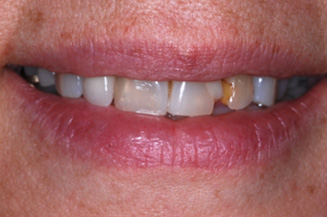smile makeover with 2 implants and 6 crowns on teeth and implants, in a single visit