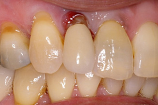 single implant and crown