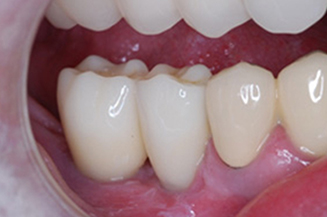 2 implants and crowns in a single visit
