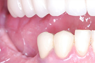 2 implants and crowns in a single visit