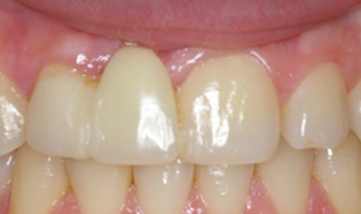 smile makeover with 1 implant and crown, and 3 veneers