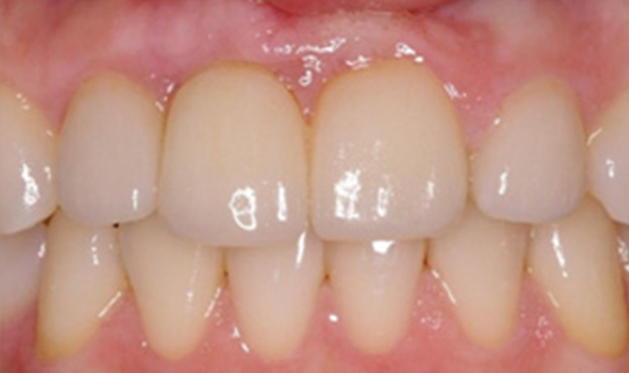 smile makeover with 1 implant and crown, and 3 veneers