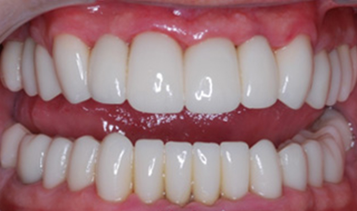 full mouth reconstruction with multiple implants & individual crowns on teeth and implants