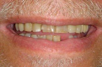 full mouth reconstruction with 2 full arch bridges and 12 implants