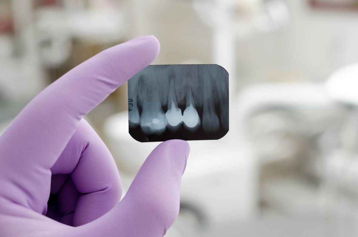 featured image for why would a dentist refer you to an endodontist